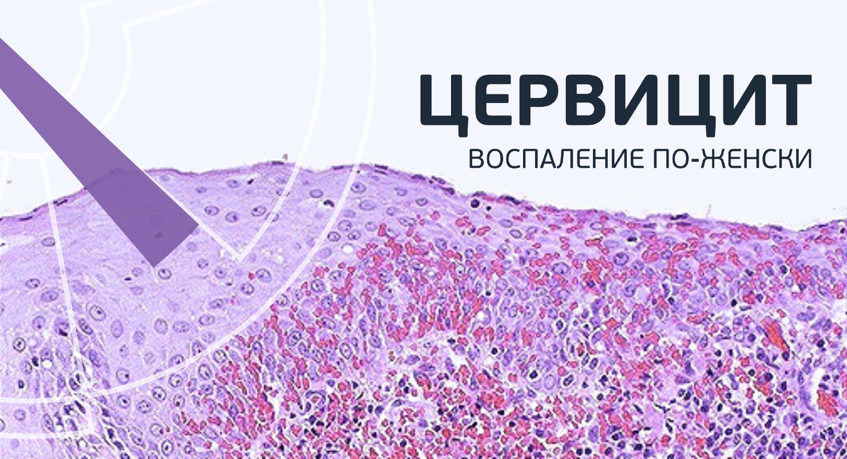 Что такое цервицит и чем он опасен: простое объяснение для каждой женщины