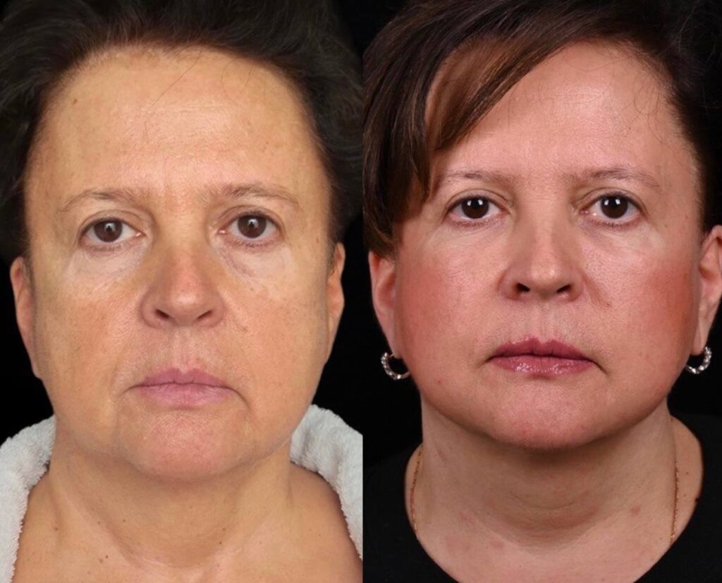 Подтяжка лица и шеи MACS lift.Фото до и после. Фото с сайта хирурга Д.Р. Гришкяна. Имеются противопоказания, требуется консультация специалиста.