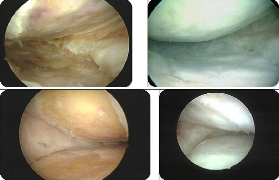 Юрген Тофт является основоположником метода восстановления хряща коленного сустава. Он наносил новые специальные повреждения в зоне пораженного участка, благодаря чему в течение приблизительно трех месяцев вырастал новый хрящ