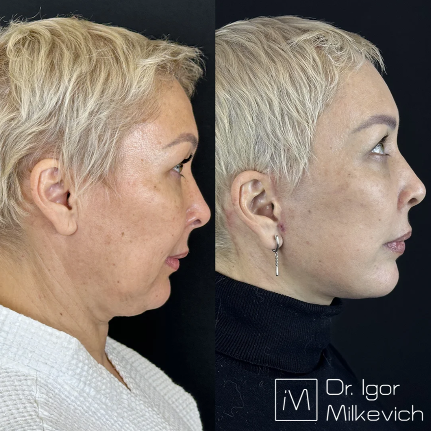 Месяц после смас-лифтинга