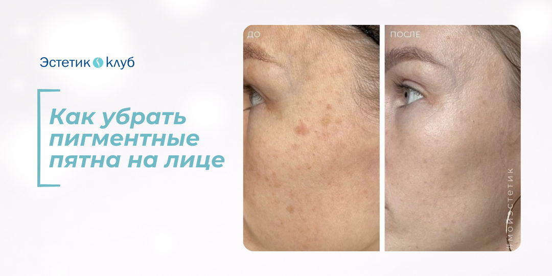 Как убрать пигментные пятна на лице: причины и эффективные способы