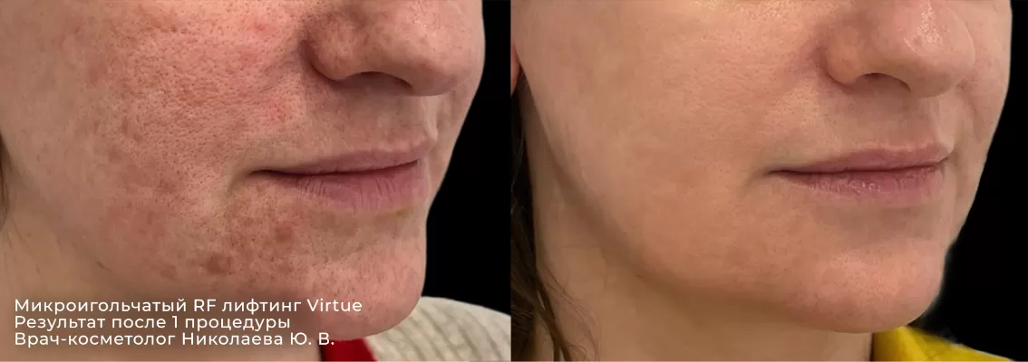 Игольчатый РФ лифтинг Virtue - результат после 1 процедуры | клиника косметологии GEN87