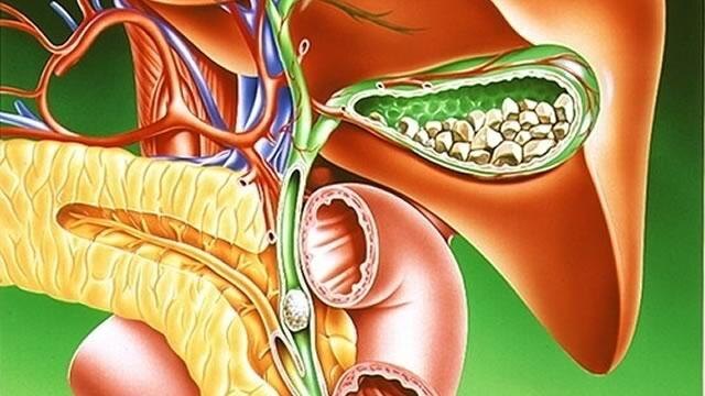 Желчнокаменная болезнь (обзорная статья доктора Вялова С.С.)