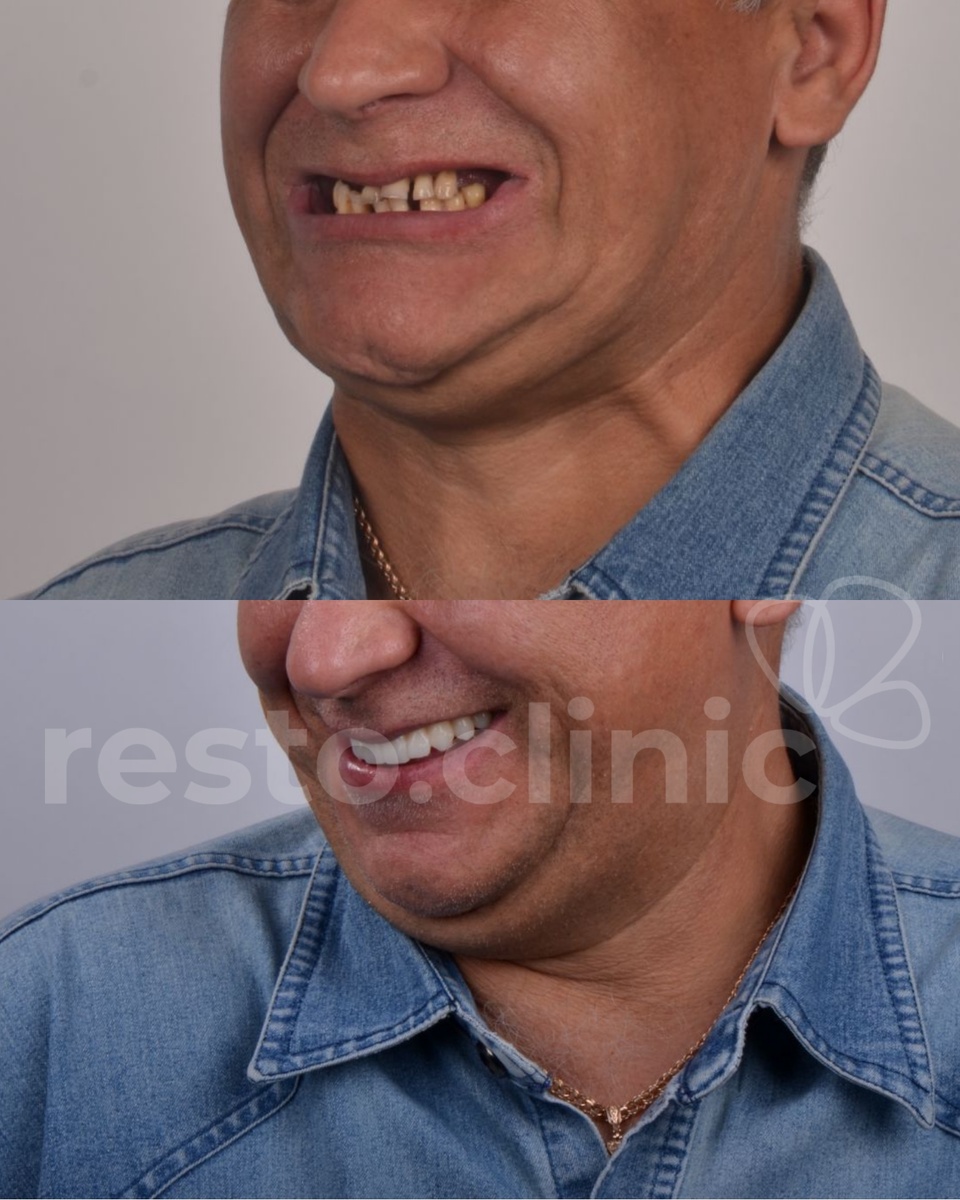 All-on-4 в Ижевске