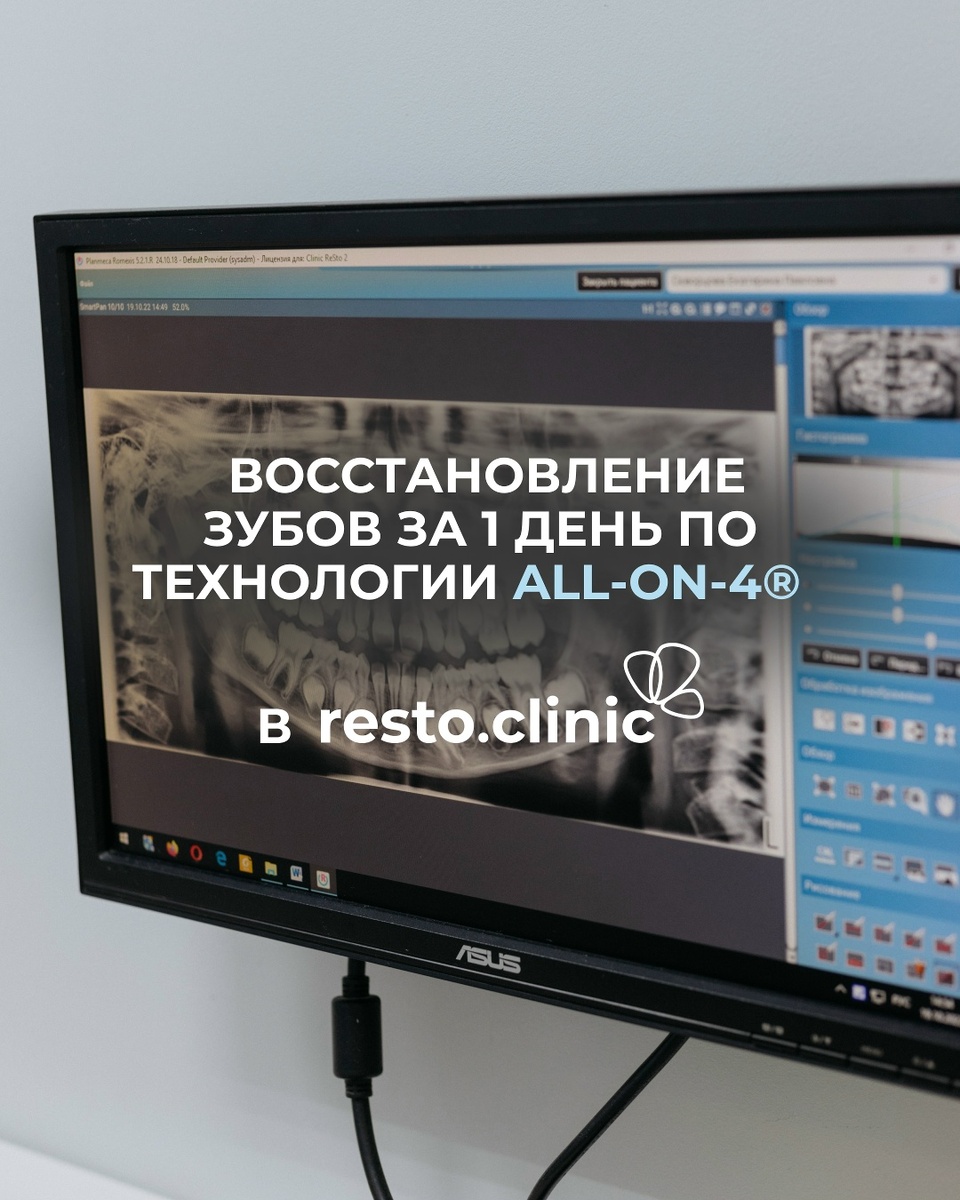 All‑on‑4 в Ижевске