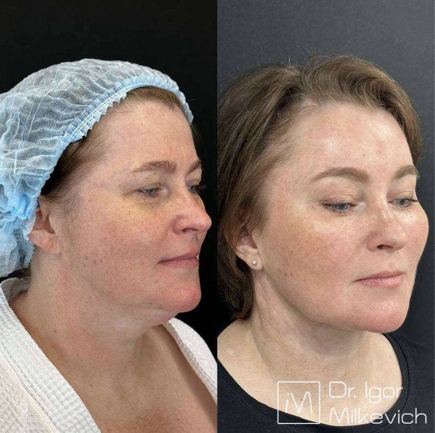 Месяц после операции. Были выполнены: лифтинг верхней и средней трети лица + изолировванный глубокий лифтинг шеи. 