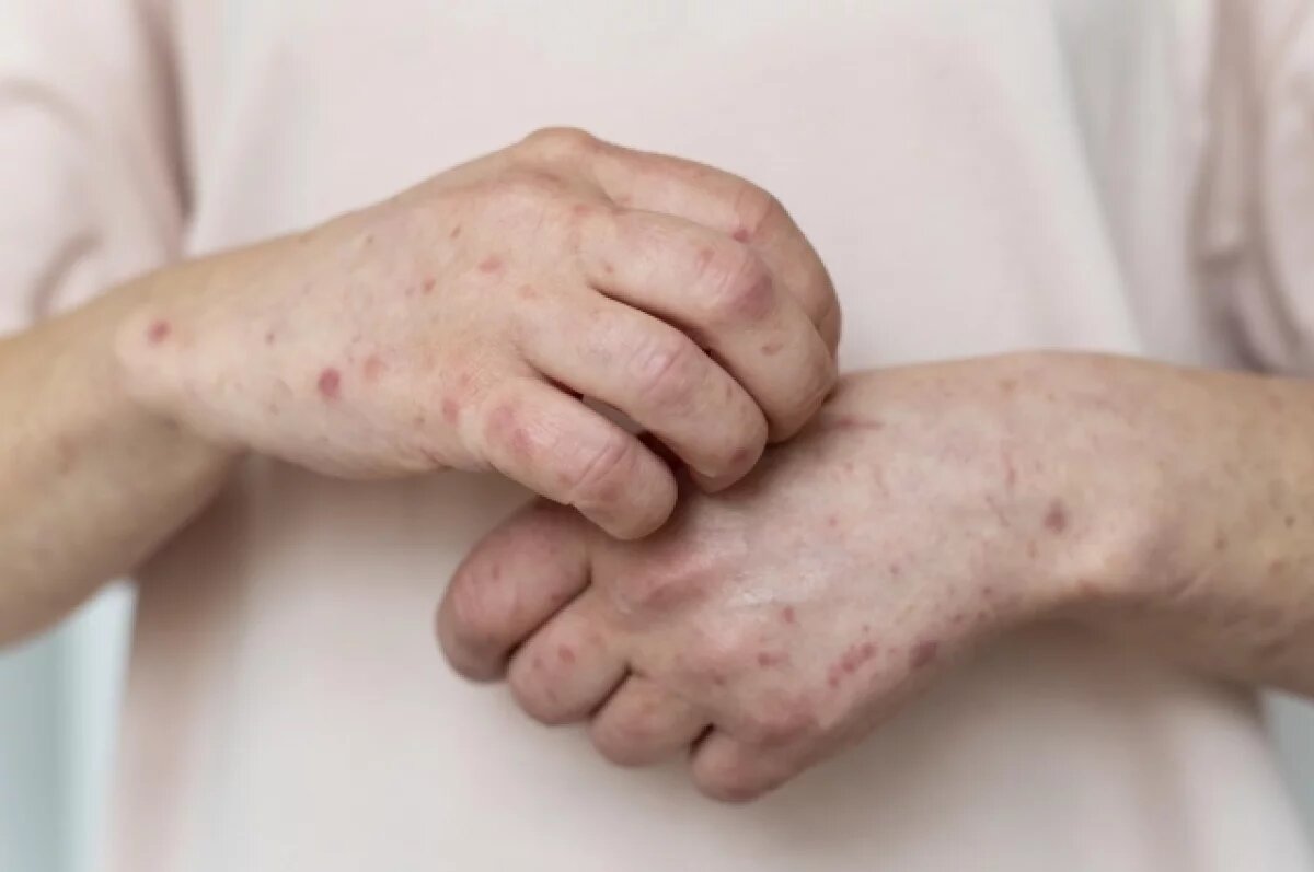    Жителей Тверской области предупредили о распространении кори