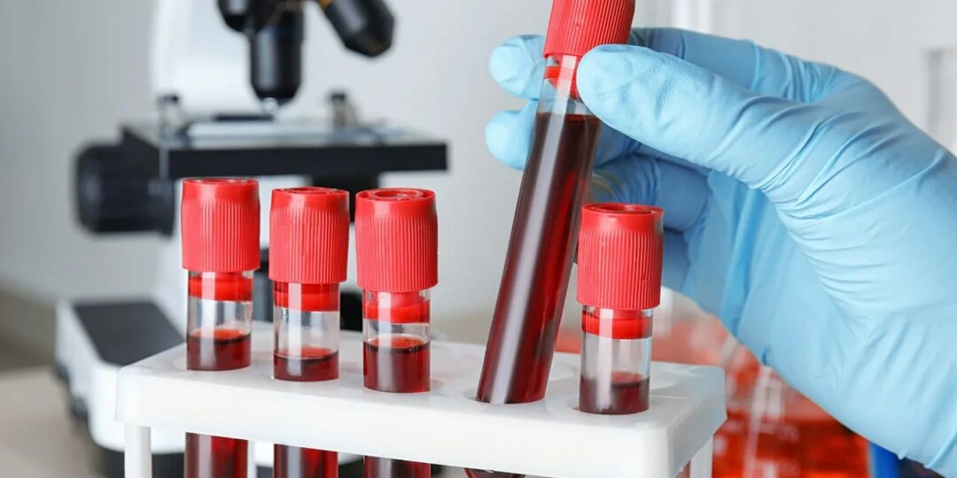 Какие анализы покажут тромб до того, как случится беда