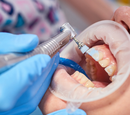 отбеливание зубов