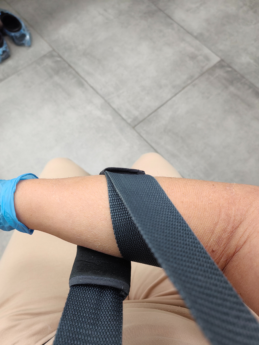 Первые минуты без гипса. Если присмотреться - видны следы от трикотажного "рукава"