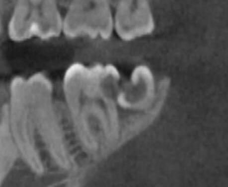 Кариес 7 и 8 - срез КТ