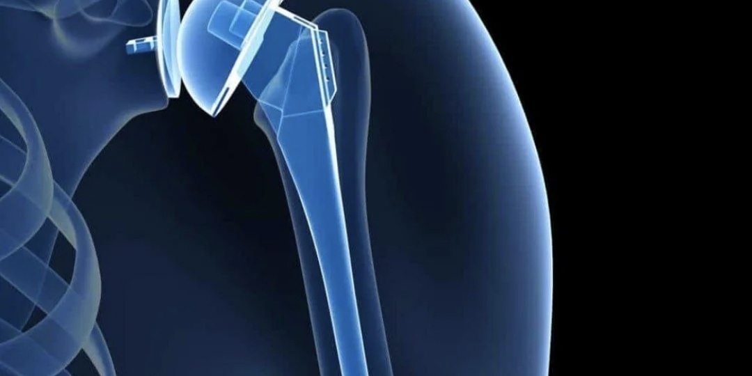 МЕНЯЕМ ПЛЕЧЕВОЙ СУСТАВ