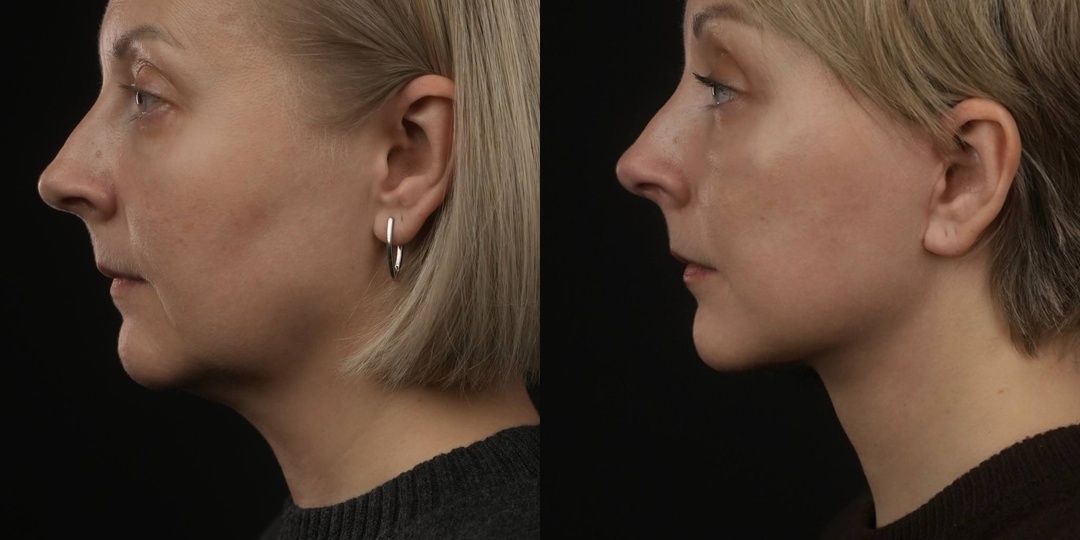 1,5 месяца после фейслифтинга, лобно-височного лифтинга