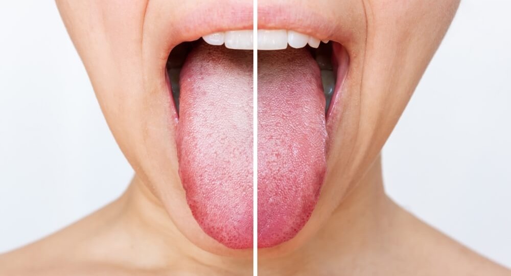 Язык как открытая книга: что налет расскажет о вашем здоровье раньше врачей
