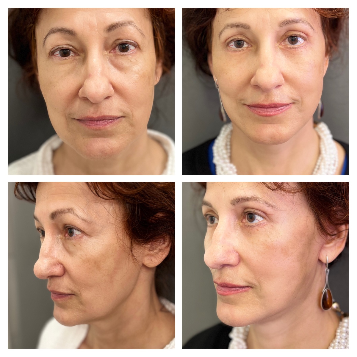 SMAS-лифтинг лица фото