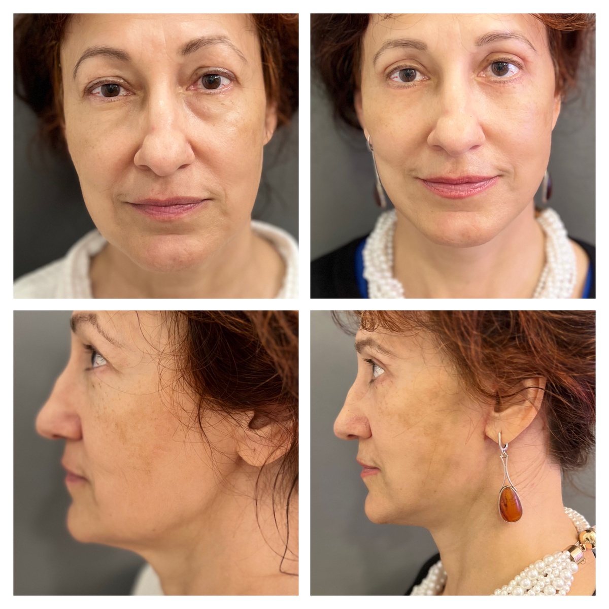 SMAS-лифтинг лица фото