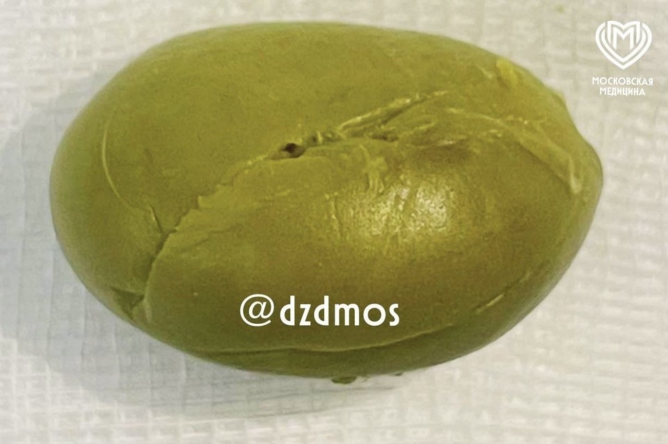    Московские врачи спасли шестилетнего ребенка, в желудке которого застряла оливка. Фото: столичный департамент здравоохранения