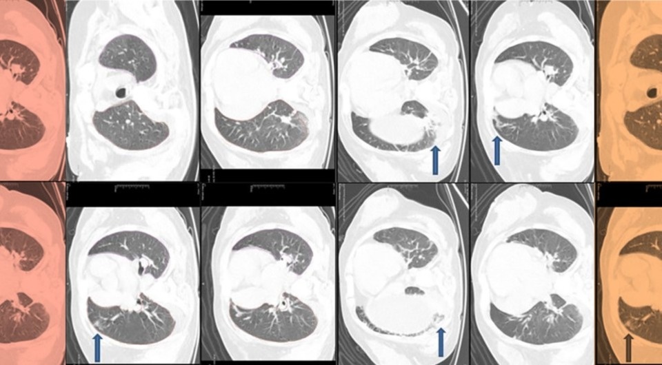   N + 1; Jinal Soni et al. / BMJ Case Reports, 2026