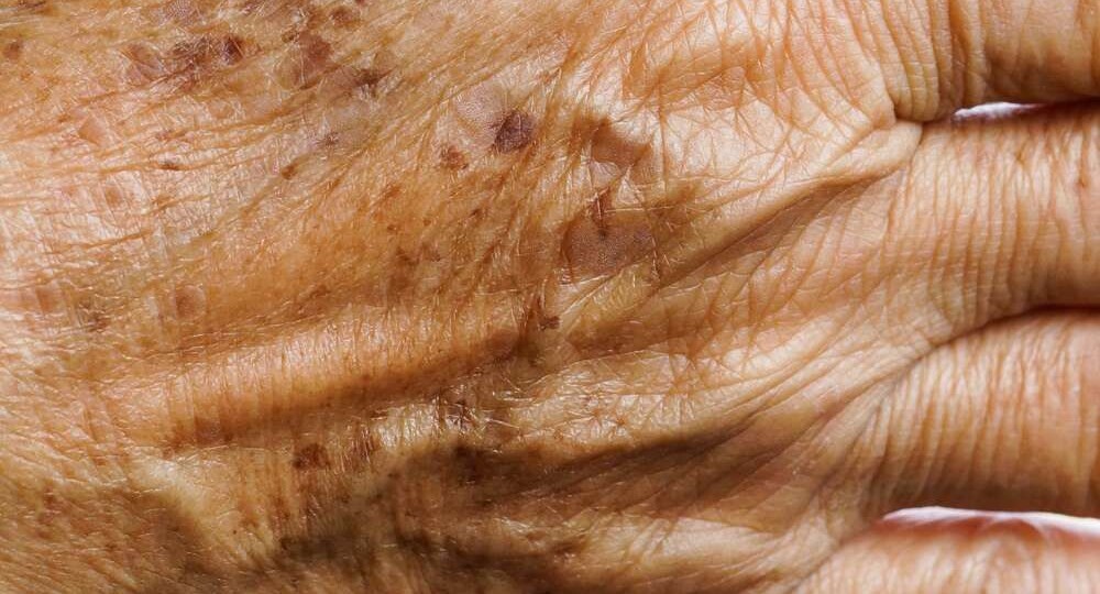 Кератомы: что это за коричневые бляшки на коже и что с ними делать