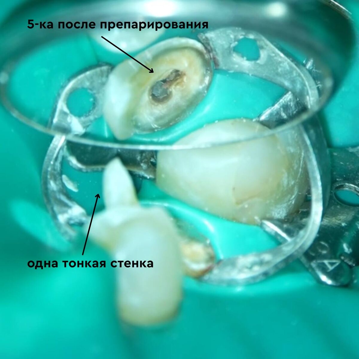 В стоматологическом зеркале отражается препарированный зуб. Практически под ноль. Лишь небольшой "парус" из одинокой стенки, которой дулось выжить.