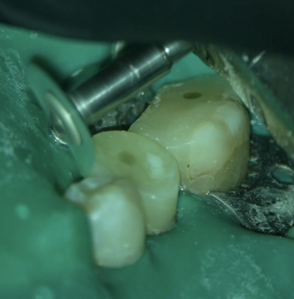 А здесь зуб уже обзавелся штифтом и новым каркасом вокруг этого штифта. Готовность к коронке номер 1!