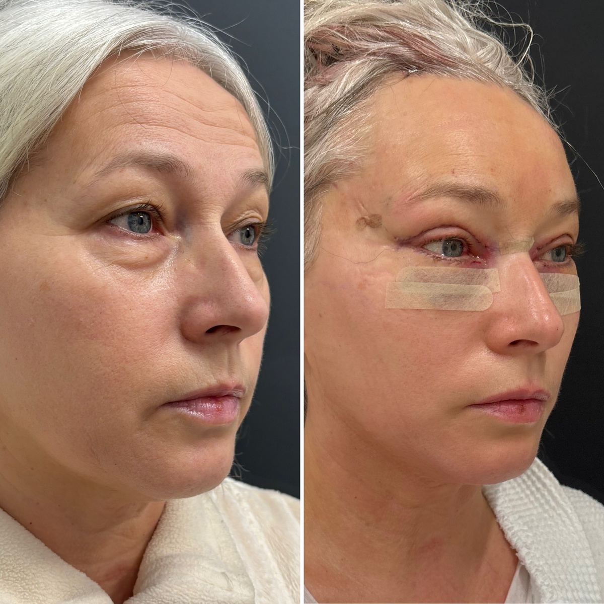 Круговая блефаропластика, эндоскопическая периорбитопластика: 1-е сутки после операции ( слева- до, справа- после).  Хирург к.м.н. Остринская Т.В.