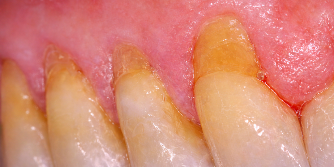 Рецессия десны. Что будет, если не лечить?