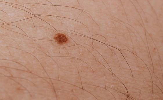 Значение родинок на теле мужчины