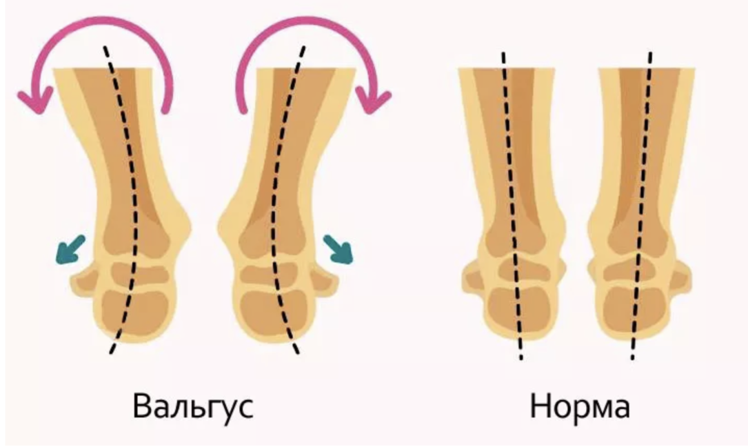                                                 Рис.1 Вальгусная деформация и норма
