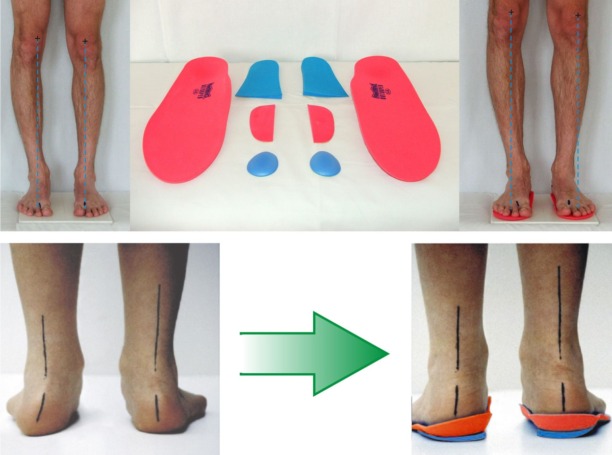   Рис.2 Коррекция вальгусной деформации голеностопного сустава с помощью индивидуальных      ортопедических стелек 