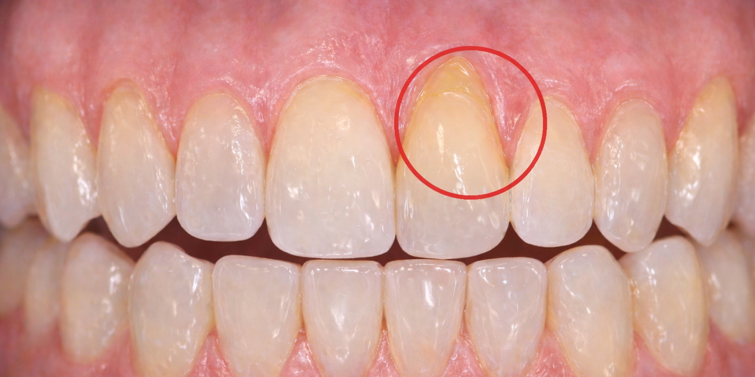 Классификация рецессии десны по Кайро