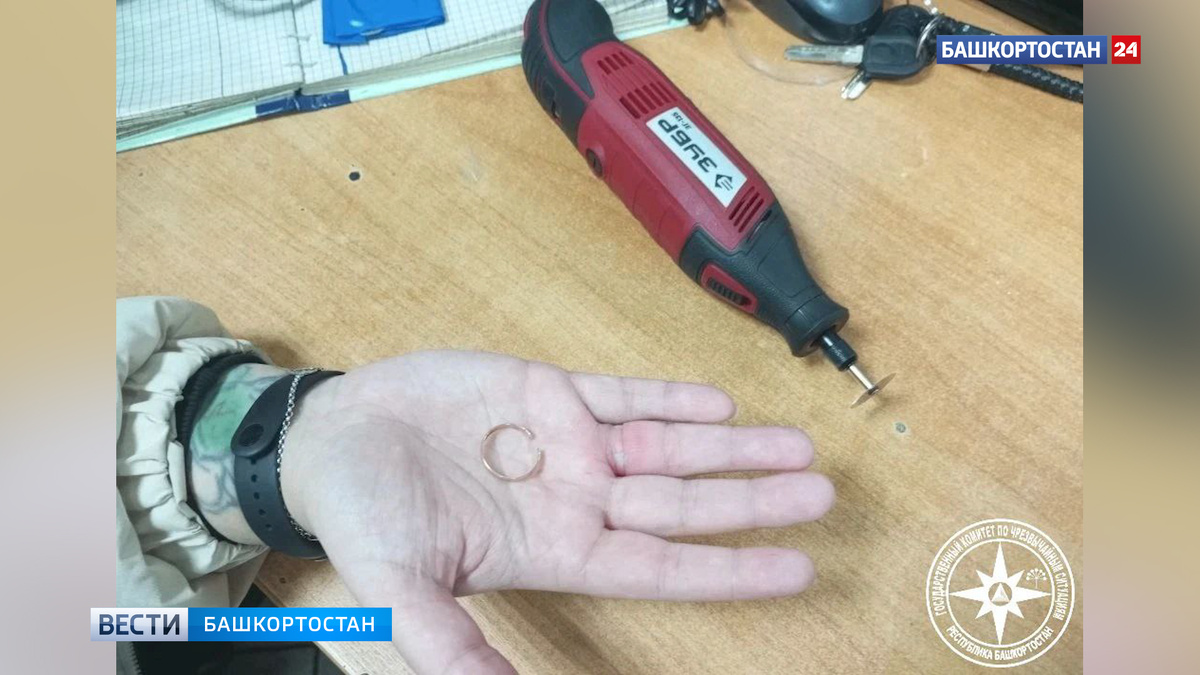    В Башкортостане спасатели помогли девушке снять кольцо с опухшего пальца