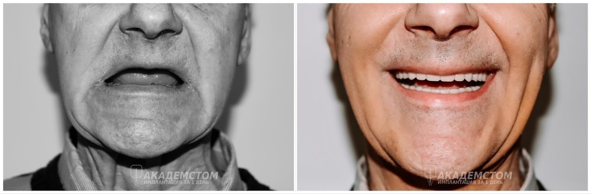 Посмотрите, как изменилось лицо пациента после полной имплантации зубов. 