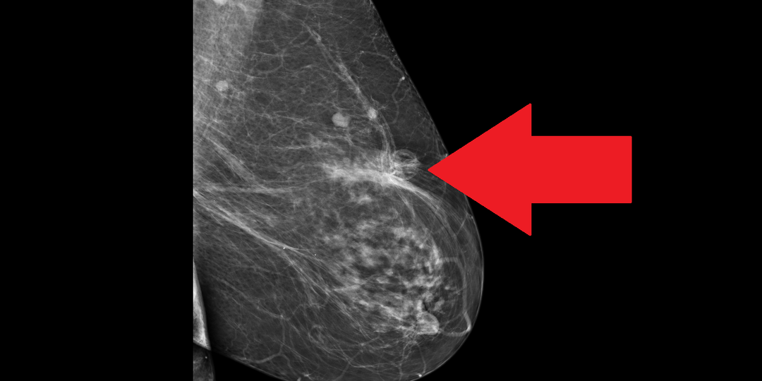 Ошибка маммографии или рецидив рака? Разбор случая из моей практики