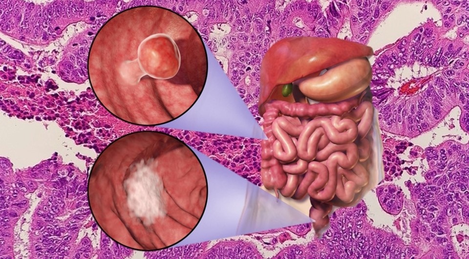   N + 1; Mikael Häggström / Wikimedia Commons / CC0 1.0; Blausen Medical Communications, Inc. / Wikimedia Commons / CC BY 3.0
