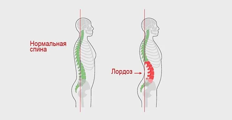 ЗАЧЕМ НУЖЕН ПРЕСС ПРИ ГИПЕРЛОРДОЗЕ