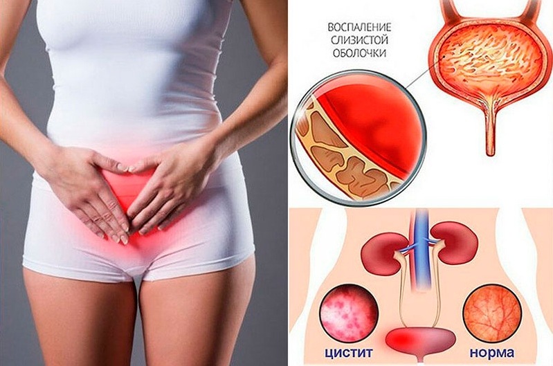 Цистит после секса