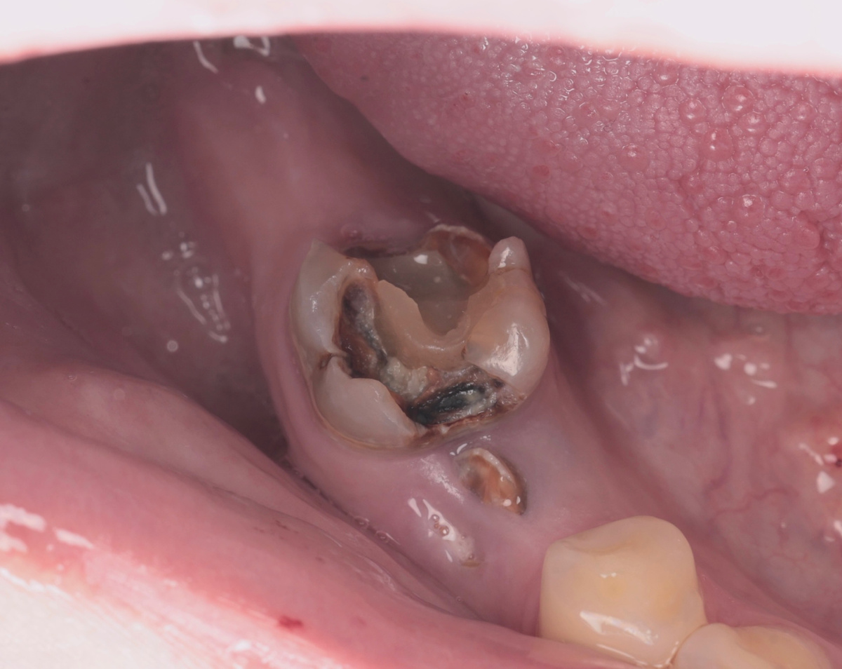 Разрушенный 4.6 зуб