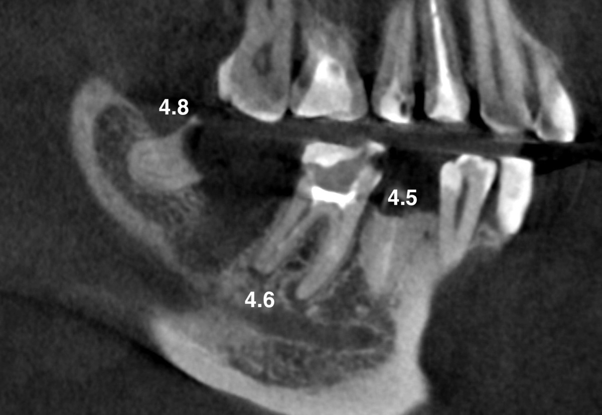 КТ до лечения и удаления