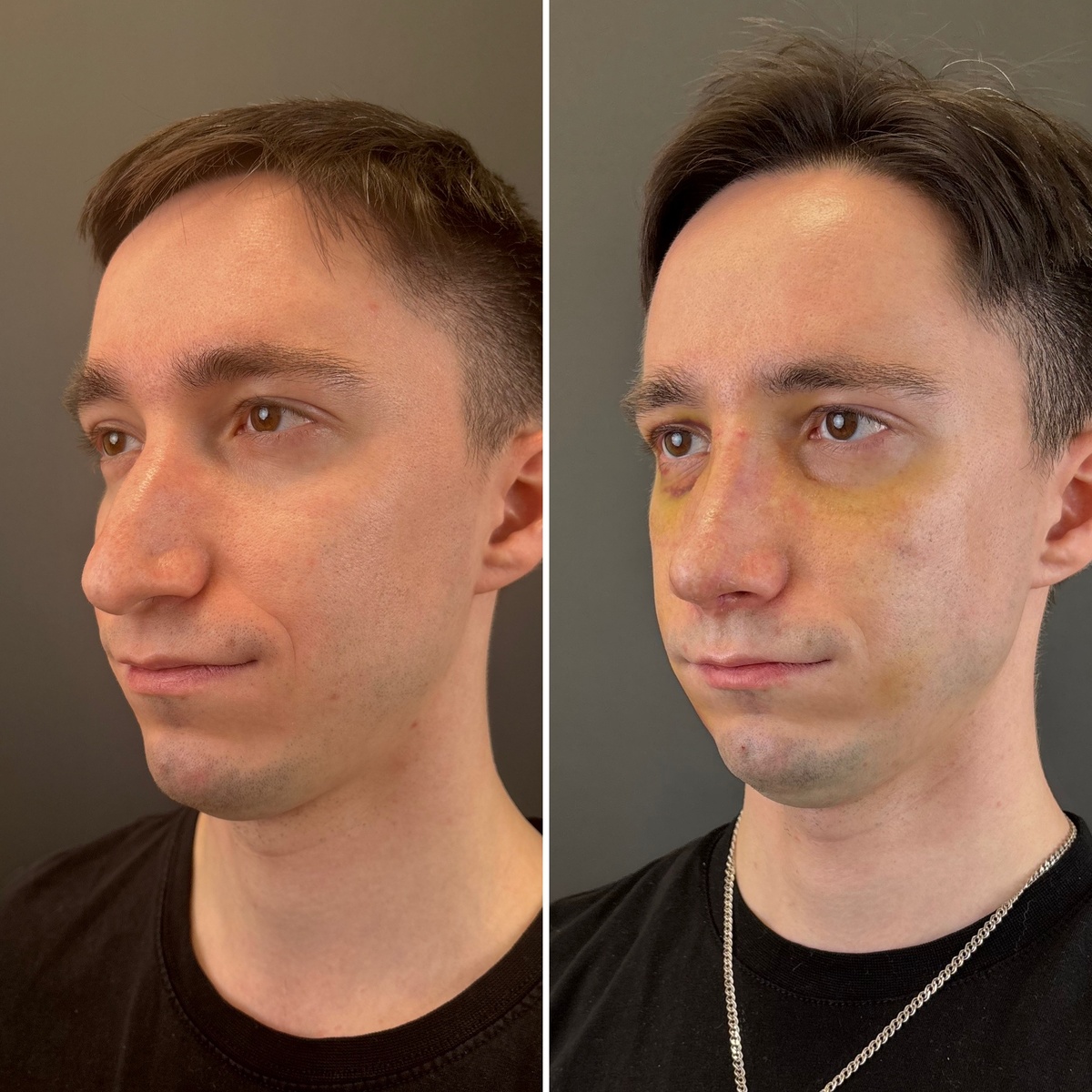 Риносептопластика: 10-е сутки после операции (слева- до, справа- после). Хирург Остринская Т.В.