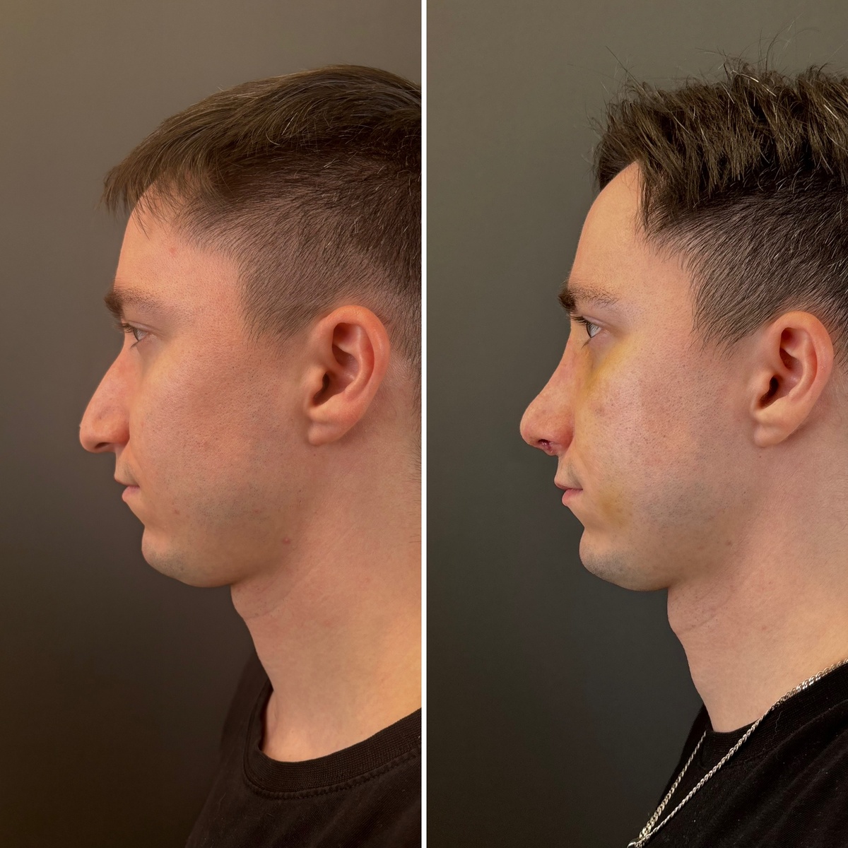 Риносептопластика: 10-е сутки после операции (слева- до, справа- после). Хирург Остринская Т.В.