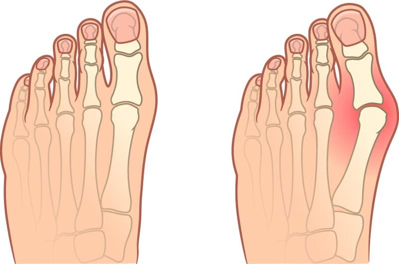 На изображении показан Hallux Valgus