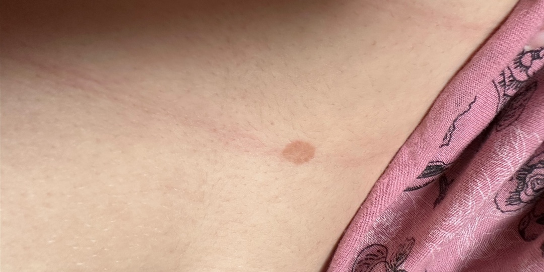 Пятно на коже, которое растёт — что врачи проверяют в первую очередь