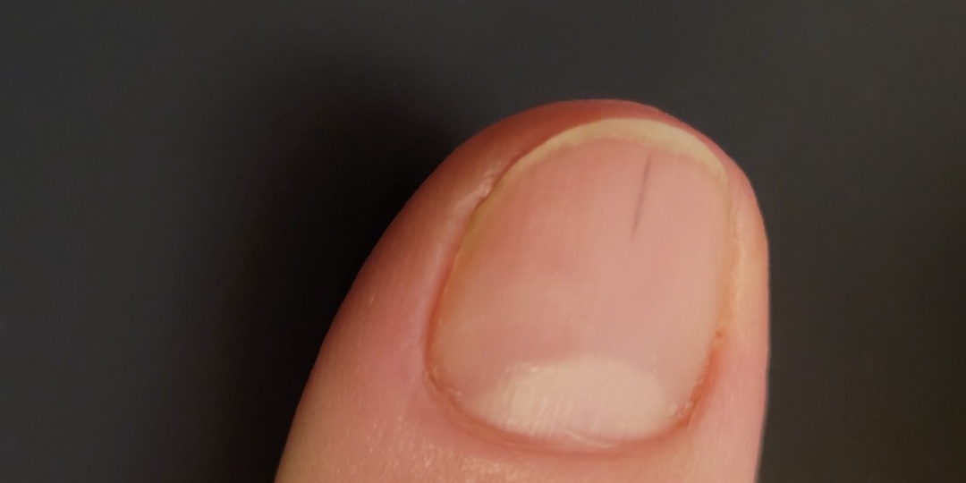 Тёмная полоса под ногтем — что исключают специалисты