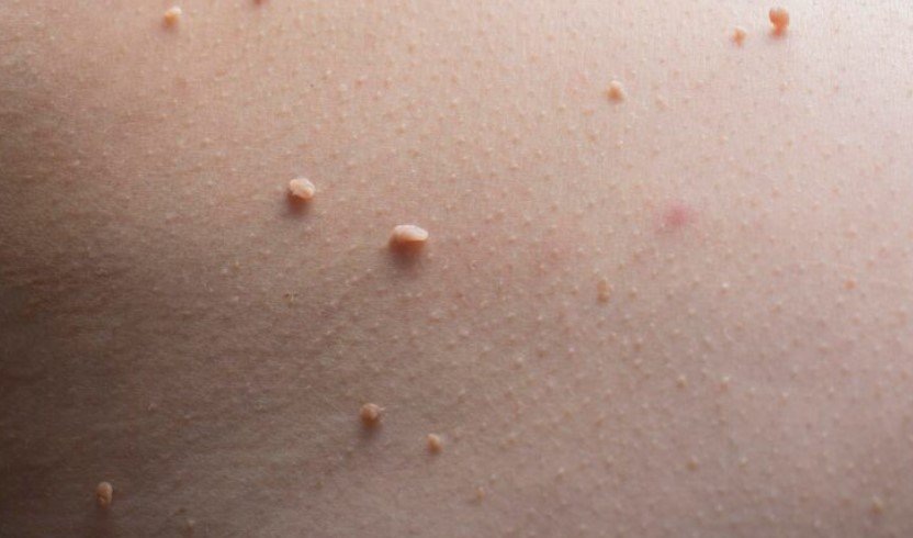    Учёные раскрыли генетические причины неэффективного иммунного ответа на папилломы