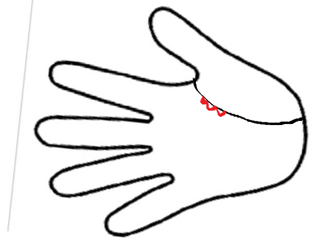 Моя редакция на  шалоне изображения руки. Знак риска для грудных желез. 