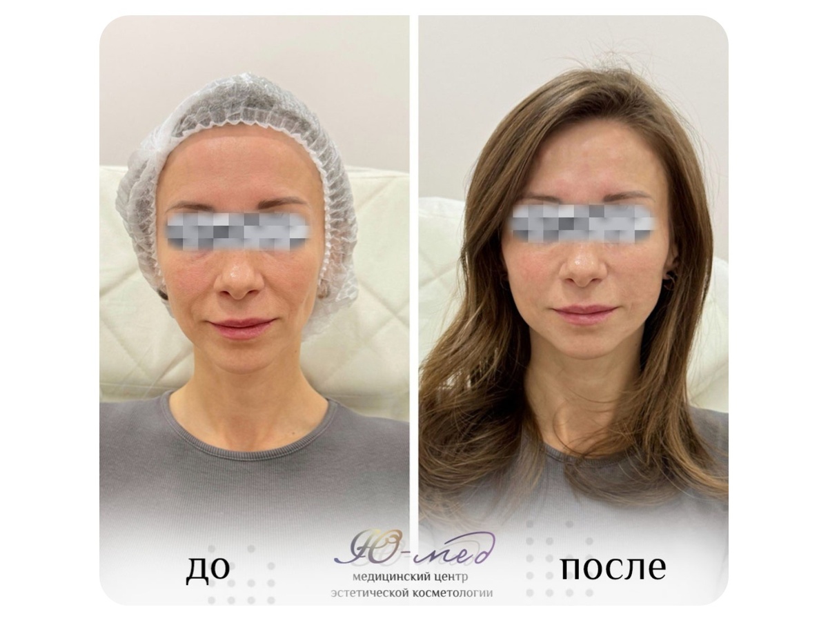 Восстановления объема и упругости тканей лица