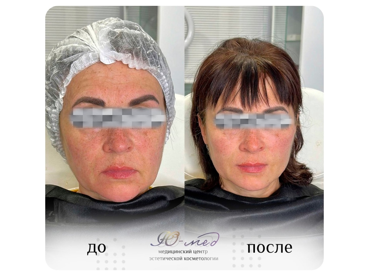 Выработка собственного коллагена с полимолочной кислотой