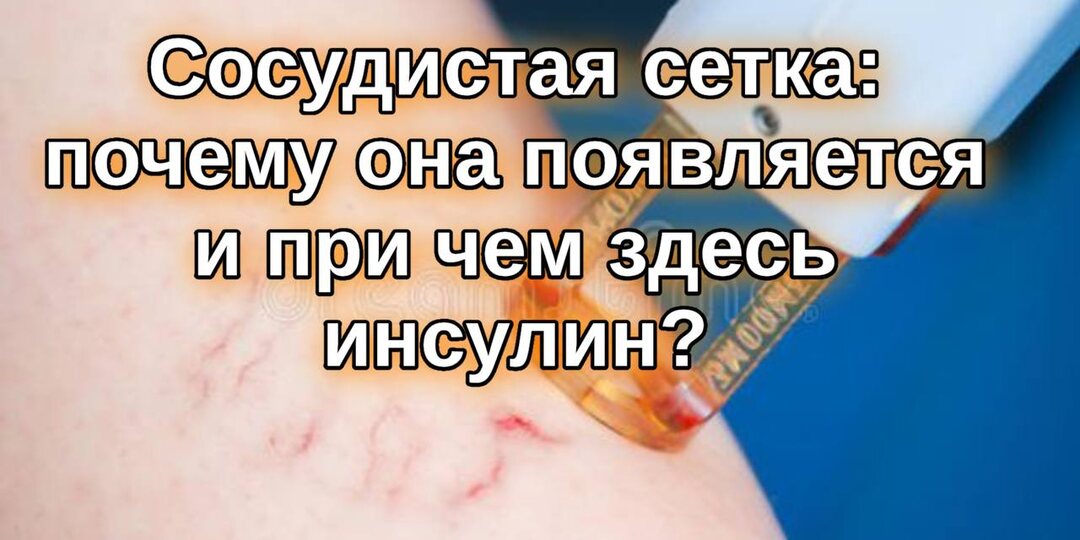 Сосудистая сетка на ногах и лице: почему она появляется и при чём здесь инсулин?