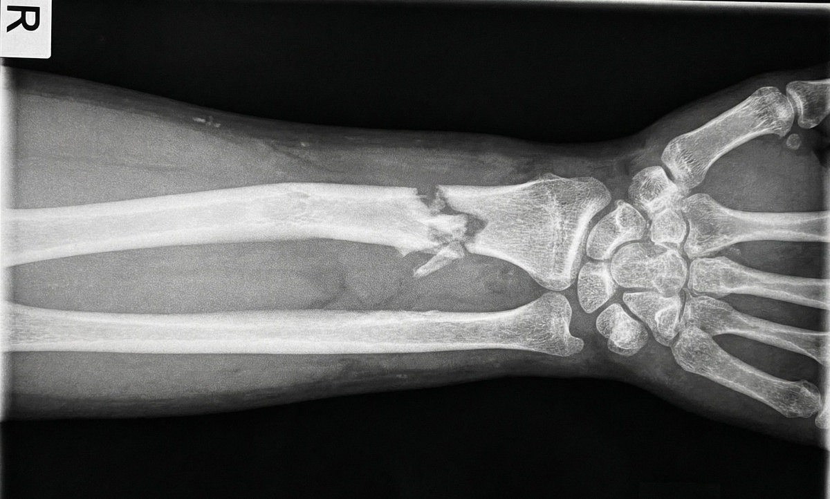 Фото рентгена перелома лучевой кости